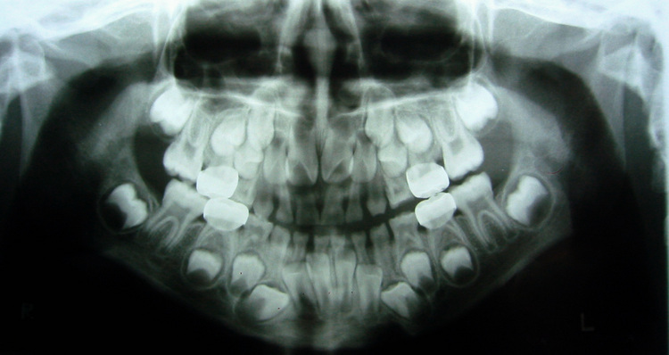 X-ray of mouth full of teeth
